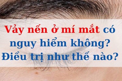 Vảy nến ở mí mắt có nguy hiểm không? Điều trị như thế nào?